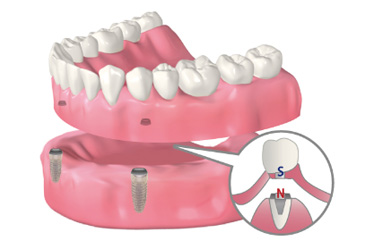 インプラントアタッチメントデンチャー